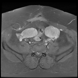 File:Adenomyosis within a didelphys uterus (Radiopaedia 70175-80215 Axial T1 C+ fat sat 16).jpg