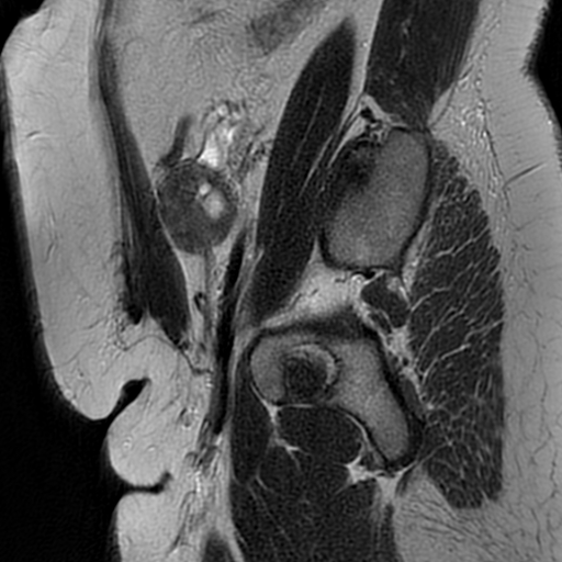 File:Adenomyosis within a didelphys uterus (Radiopaedia 70175-80215 Sagittal T2 33).jpg