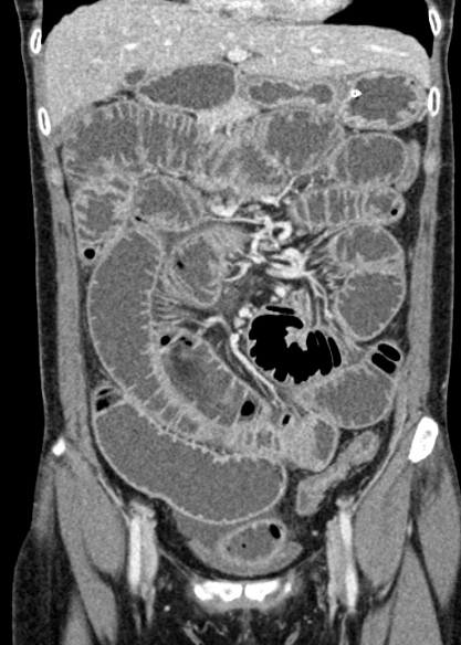 Adhesional small bowel obstruction (Radiopaedia 48397-53305 Coronal C+ portal venous phase 122).jpg