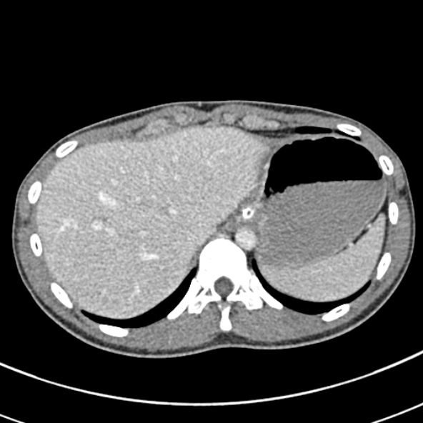 Adhesional small bowel obstruction (Radiopaedia 52107-57980 Axial C+ portal venous phase 18).jpg