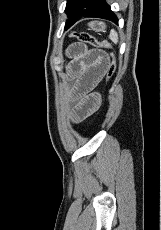 Adhesional small bowel obstruction (Radiopaedia 58900-66131 Sagittal C+ portal venous phase 223).jpg