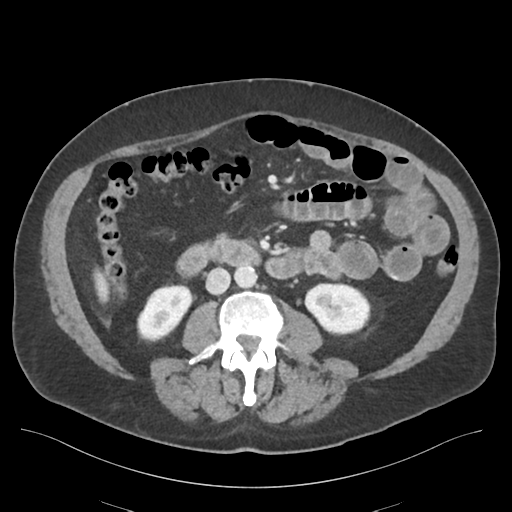 Adhesions within abdominal wall hernia (Radiopaedia 58283-65394 Axial C+ portal venous phase 42).png
