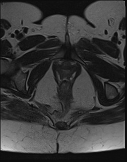 File:Adnexal multilocular cyst (O-RADS US 3- O-RADS MRI 3) (Radiopaedia 87426-103754 Axial T2 24).jpg