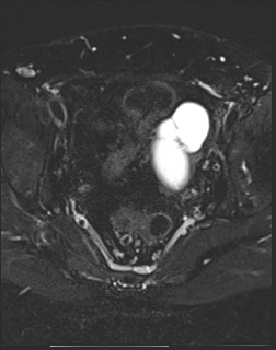 File:Adnexal multilocular cyst (O-RADS US 3- O-RADS MRI 3) (Radiopaedia 87426-103754 Axial T2 fat sat 14).jpg
