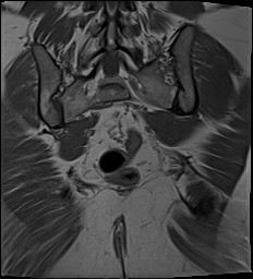 File:Adnexal multilocular cyst (O-RADS US 3- O-RADS MRI 3) (Radiopaedia 87426-103754 Coronal 27).jpg