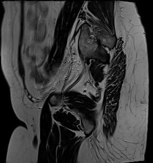 File:Adnexal multilocular cyst (O-RADS US 3- O-RADS MRI 3) (Radiopaedia 87426-103754 Sagittal T2 2).jpg