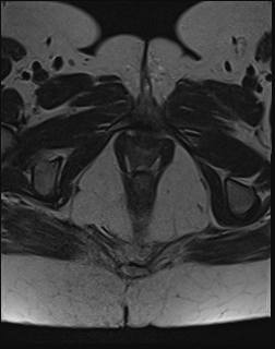 File:Adnexal multilocular cyst (O-RADS US 3. O-RADS MRI 3) (Radiopaedia 87426-103754 Axial 25).jpeg