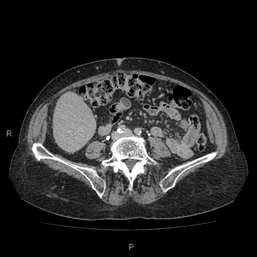 File:Adrenal collision tumor (ACT) (Radiopaedia 48462-53379 Axial C+ delayed 41).jpg
