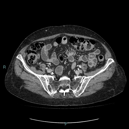 File:Adrenal collision tumor (ACT) (Radiopaedia 48462-53379 Axial C+ portal venous phase 46).jpg