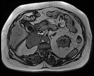 File:Adrenal cortical carcinoma (Radiopaedia 64017-72770 Axial T1 out-of-phase 30).jpg