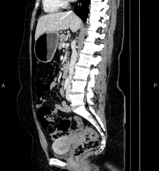 File:Adrenal cortical carcinoma (Radiopaedia 84882-100379 Sagittal C+ portal venous phase 45).jpg