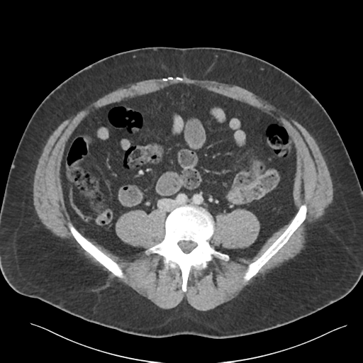 File:Adrenal cyst (Radiopaedia 45625-49777 Axial C+ portal venous phase 65).png