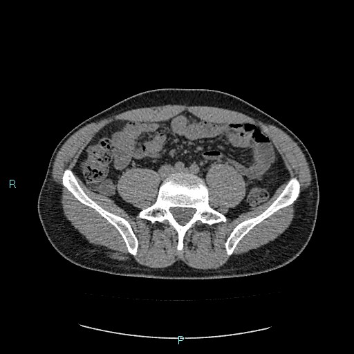 Adrenal cystic lymphangioma (Radiopaedia 83161-97534 Axial non-contrast 63).jpg