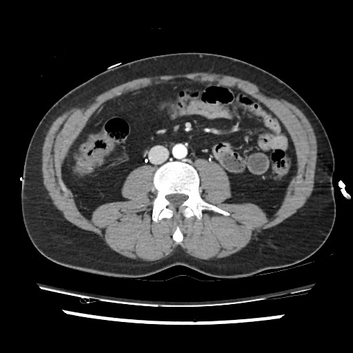 Adrenal gland trauma (Radiopaedia 81351-95078 Axial Dual bolus trauma C+ 82).jpg