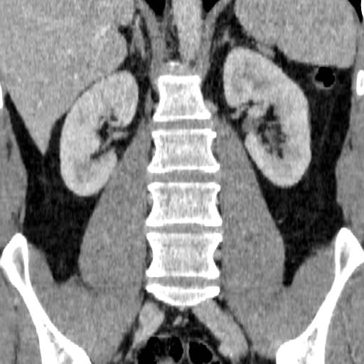 File:Adrenal glands (normal CT anatomy) (Radiopaedia 16570-105725 Coronal 10).jpg