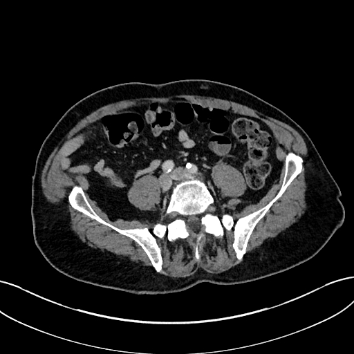 Adrenal lymphoma (Radiopaedia 73730-84529 Axial C+ portal venous phase 84).jpg