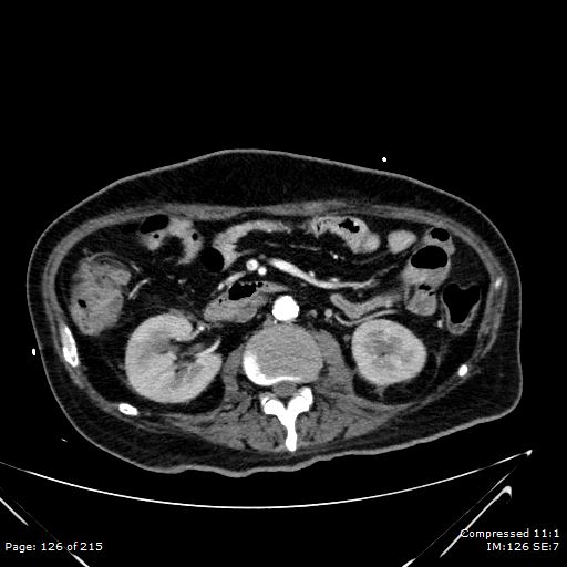 Adrenal metastasis (Radiopaedia 78425-91079 Axial C+ arterial phase 56).jpg