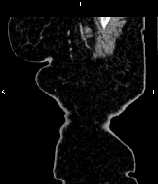 Adrenal myelolipoma (Radiopaedia 82742-96986 Sagittal renal cortical phase 8).jpg