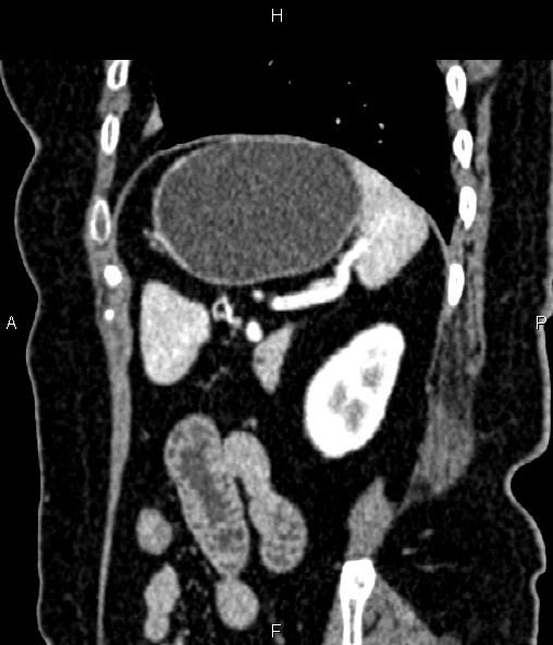 Adrenal myelolipoma (Radiopaedia 82742-96986 Sagittal renal cortical phase 84).jpg
