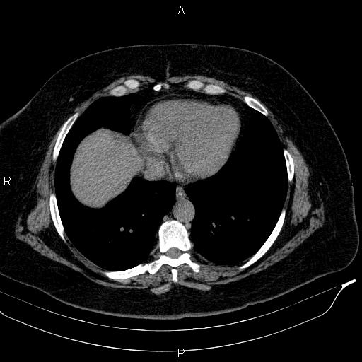 Adrenal myelolipoma (Radiopaedia 84319-99617 Axial With oral contrast 19).jpg