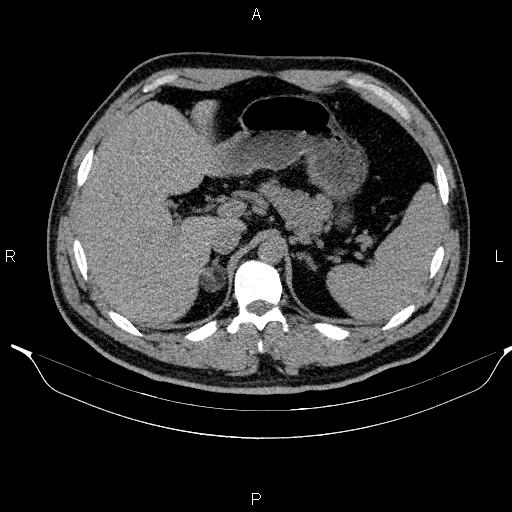 Adrenal myelolipoma (Radiopaedia 84321-99619 Axial non-contrast 30).jpg