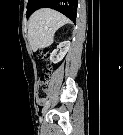 Adrenal myelolipoma (Radiopaedia 87794-104246 Sagittal renal cortical phase 28).jpg