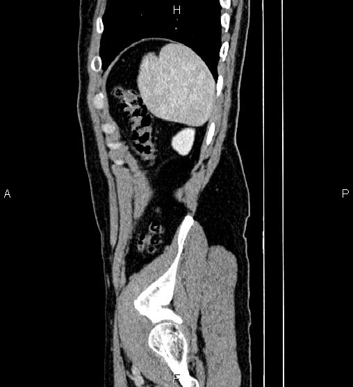 Adrenal myelolipoma (Radiopaedia 87794-104246 Sagittal renal cortical phase 83).jpg
