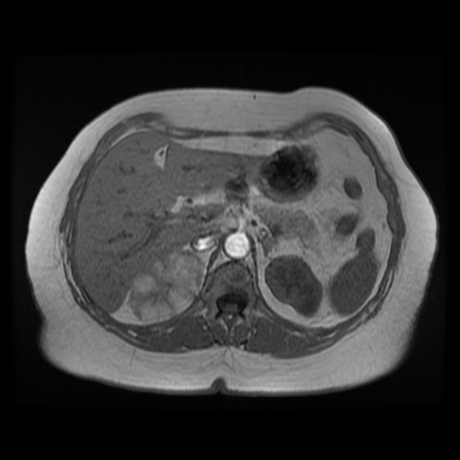 File:Adrenal myelolipoma - MRI (Radiopaedia 83249-97646 Axial T1-in phase 9).jpg