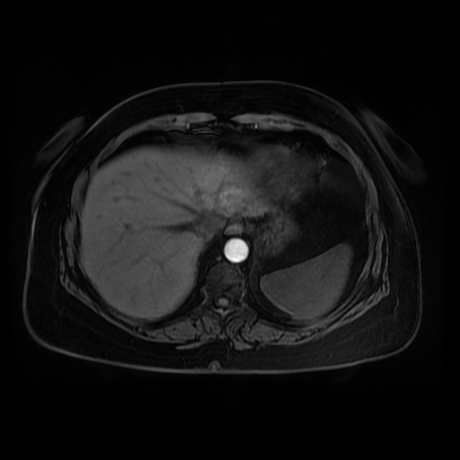Adrenal myelolipoma - MRI (Radiopaedia 83249-97646 Axial T1 fat sat 5).jpg