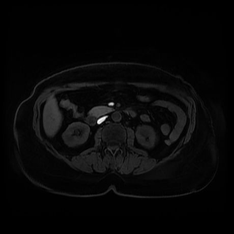 Adrenal myelolipoma - MRI (Radiopaedia 83249-97646 Axial T1 fat sat 50).jpg