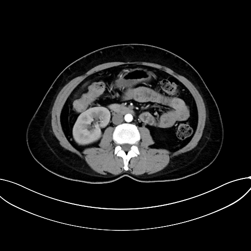 Adrenocortical carcinoma (Radiopaedia 87281-103569 Axial C+ arterial phase 44).jpg