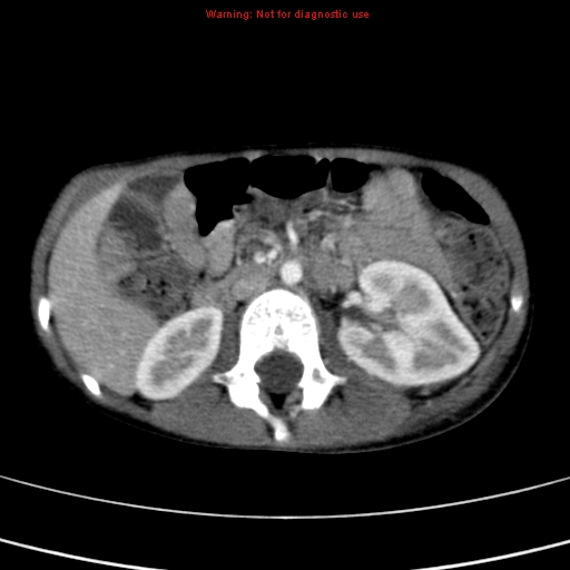 File:Adrenocortical carcinoma (Radiopaedia 9449-10131 Axial C+ portal venous phase 26).jpg