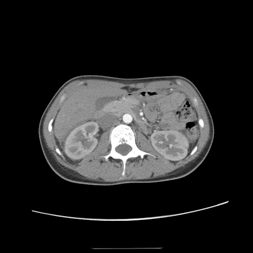 Adult polycystic kidney disease (Radiopaedia 48845-53876 Axial renal cortical phase 26).jpg