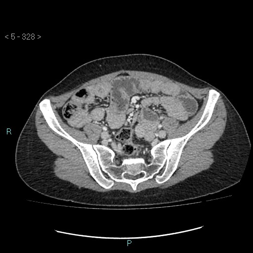 Adult transient intestinal intussusception (Radiopaedia 34853-36310 Axial C+ portal venous phase 79).jpg