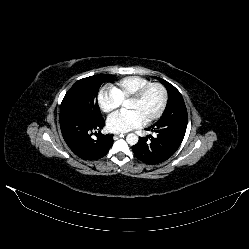 File:Afferent loop syndrome - secondary to incarcerated trocar site hernia (Radiopaedia 82959-97305 Axial C+ portal venous phase 4).jpg