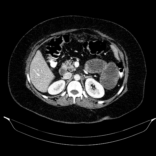 Afferent loop syndrome - secondary to incarcerated trocar site hernia (Radiopaedia 82959-97305 Axial C+ portal venous phase 85).jpg