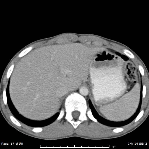 File:Agenesis of the gallbladder (Radiopaedia 55454-61905 B 17).jpg