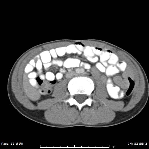 File:Agenesis of the gallbladder (Radiopaedia 55454-61905 B 55).jpg