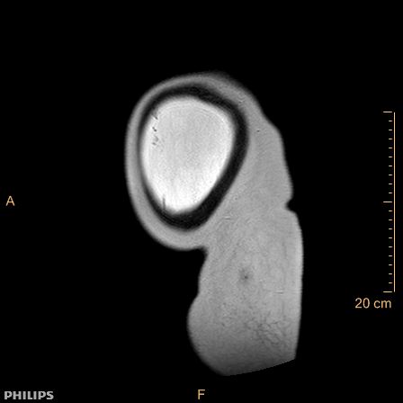 Aggressive angiomyxoma (Radiopaedia 73343-84093 Sagittal T2 2).jpg