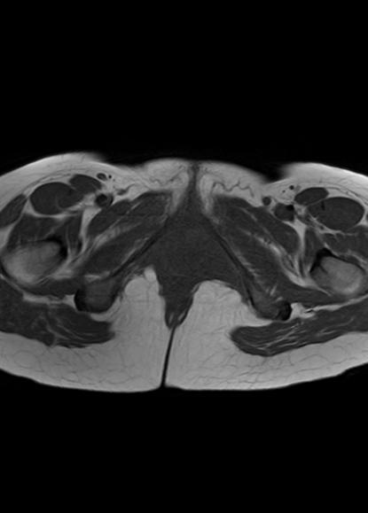 File:Aggressive angiomyxoma of the pelvis and perineum (Radiopaedia 59162-66479 T1 4).jpg