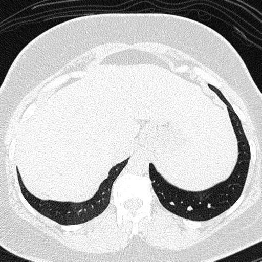 Air trapping in small airway disease (Radiopaedia 61685-69694 Axial lung window 176).jpg