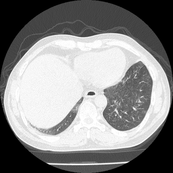 Airway foreign body in adult (Radiopaedia 85907-101779 Axial lung window 150).jpg