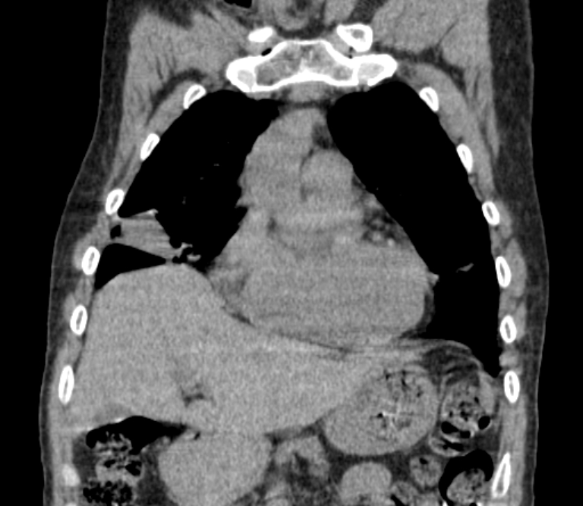 Airway foreign body in adult (Radiopaedia 85907-101779 Coronal liver window 71).jpg