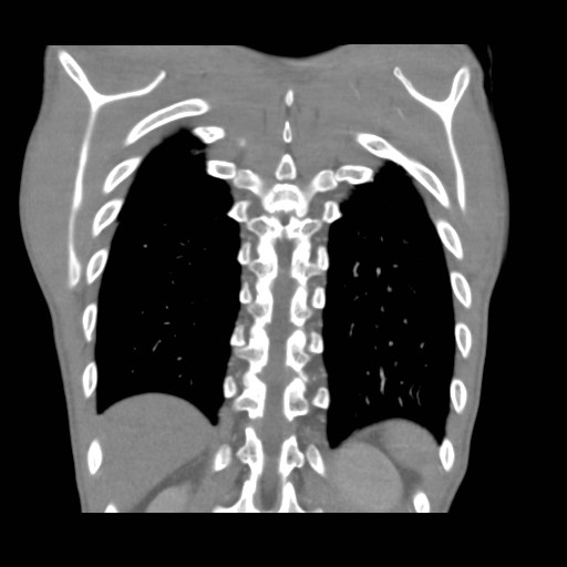 File:Alagille syndrome with pulmonary hypertension (Radiopaedia 49384-54980 C 10).jpg