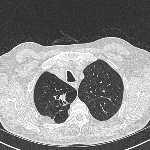 Allergic bronchopulmonary aspergillosis (Radiopaedia 44760-48571 Axial lung window 12).png