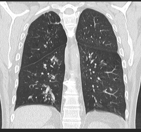 Allergic bronchopulmonary aspergillosis (Radiopaedia 44760-48571 Coronal lung window 41).png