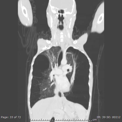 Alpha-1-antitrypsin deficiency (Radiopaedia 50561-55987 Coronal lung window 31).jpg