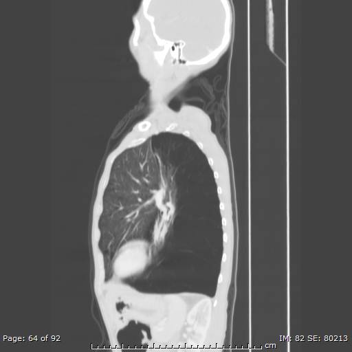 File:Alpha-1-antitrypsin deficiency (Radiopaedia 50561-55987 Sagittal lung window 31).jpg