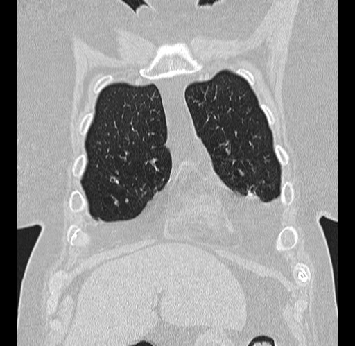 Alpha-1-antitrypsin deficiency (Radiopaedia 72058-82557 Coronal lung window 3).jpg