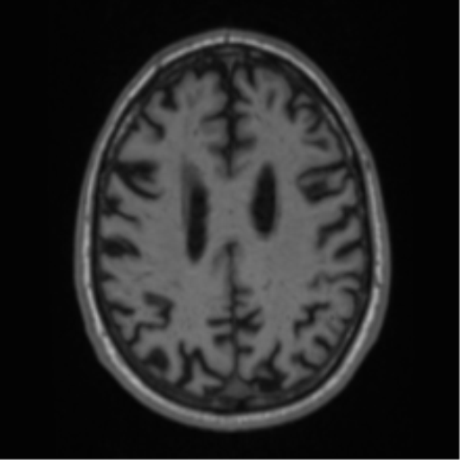Alzheimer's disease- with Gerstmann syndrome and dressing apraxia (Radiopaedia 54882-61150 Axial T1 52).png